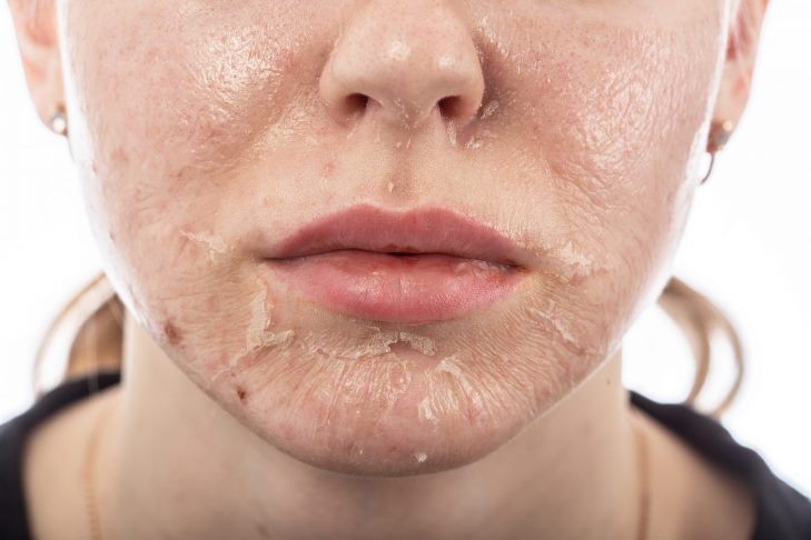 Как ухаживать за кожей лица после пилинга?